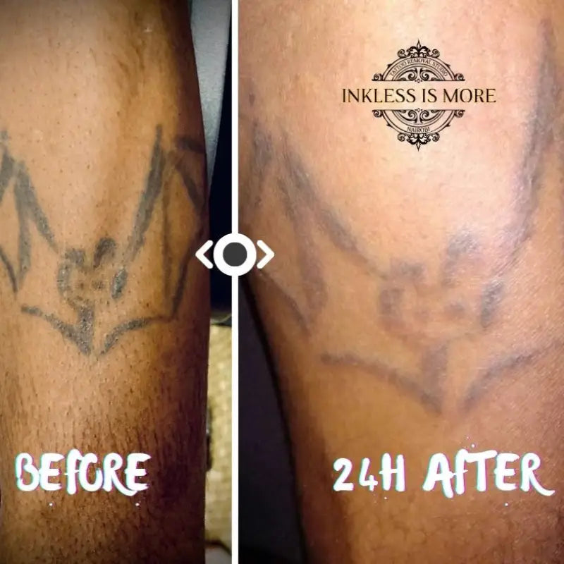 1 Single Laser Tattoo Removal Session - Single Laser Tattoo Removal Session