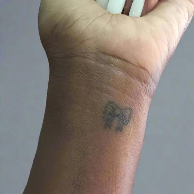 3 Laser Tattoo Removal Sessions (small size tattoo) - 3 Laser Tattoo Removal Sessions