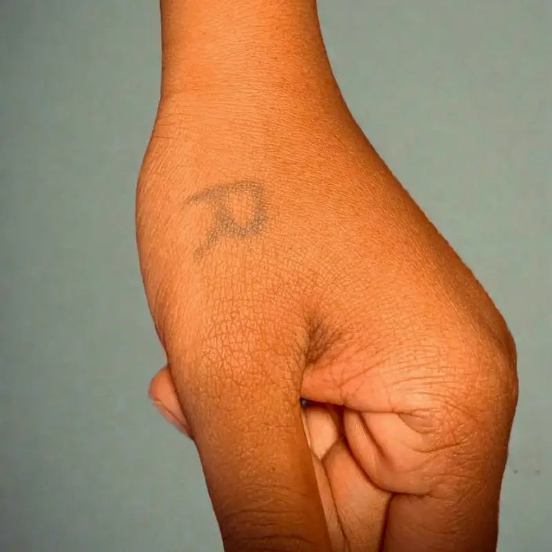 3 Laser Tattoo Removal Sessions (small size tattoo) - 3 Laser Tattoo Removal Sessions