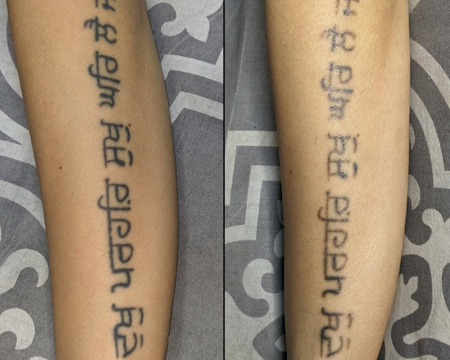 Laser tattoo removal transformation at Inkless is More