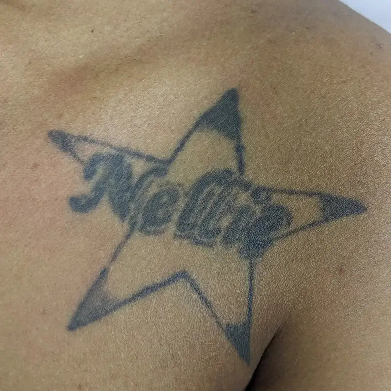 5 Laser Tattoo Removal Sessions (medium size tattoo) - 5 Laser Treatment Sessions For Tattoo Removal