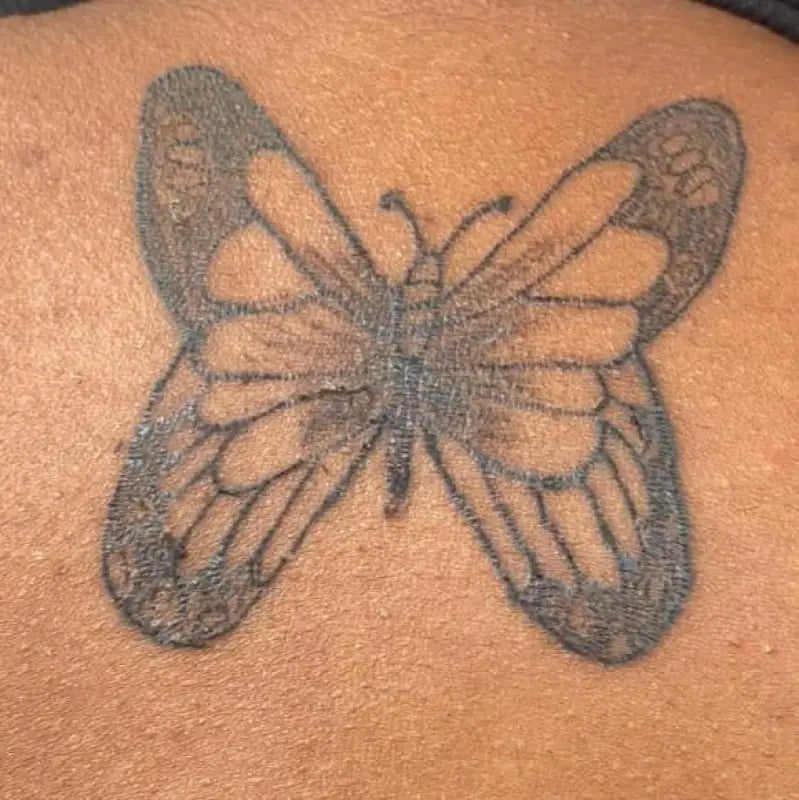 5 Laser Tattoo Removal Sessions (medium size tattoo) - 5 Laser Treatment Sessions For Tattoo Removal