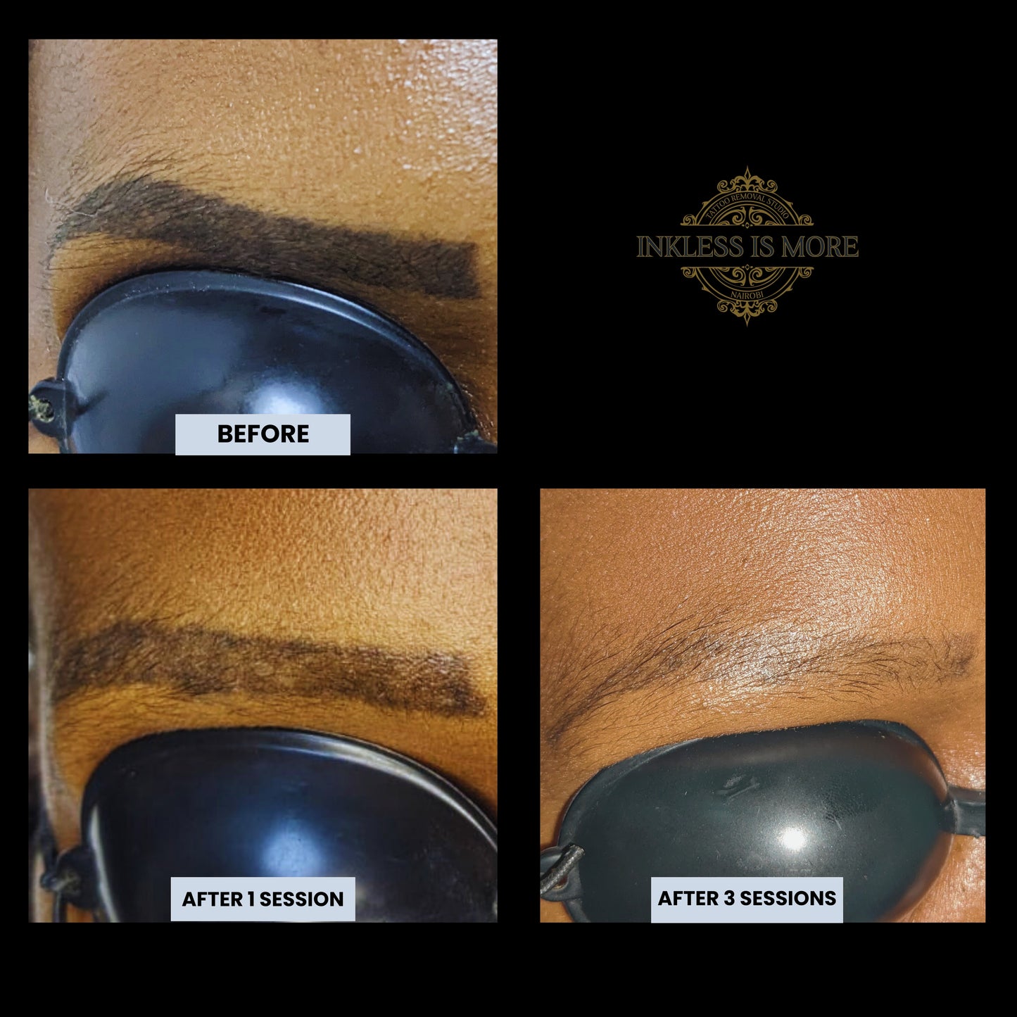 Microblading/Eyebrow Tattoo Removal