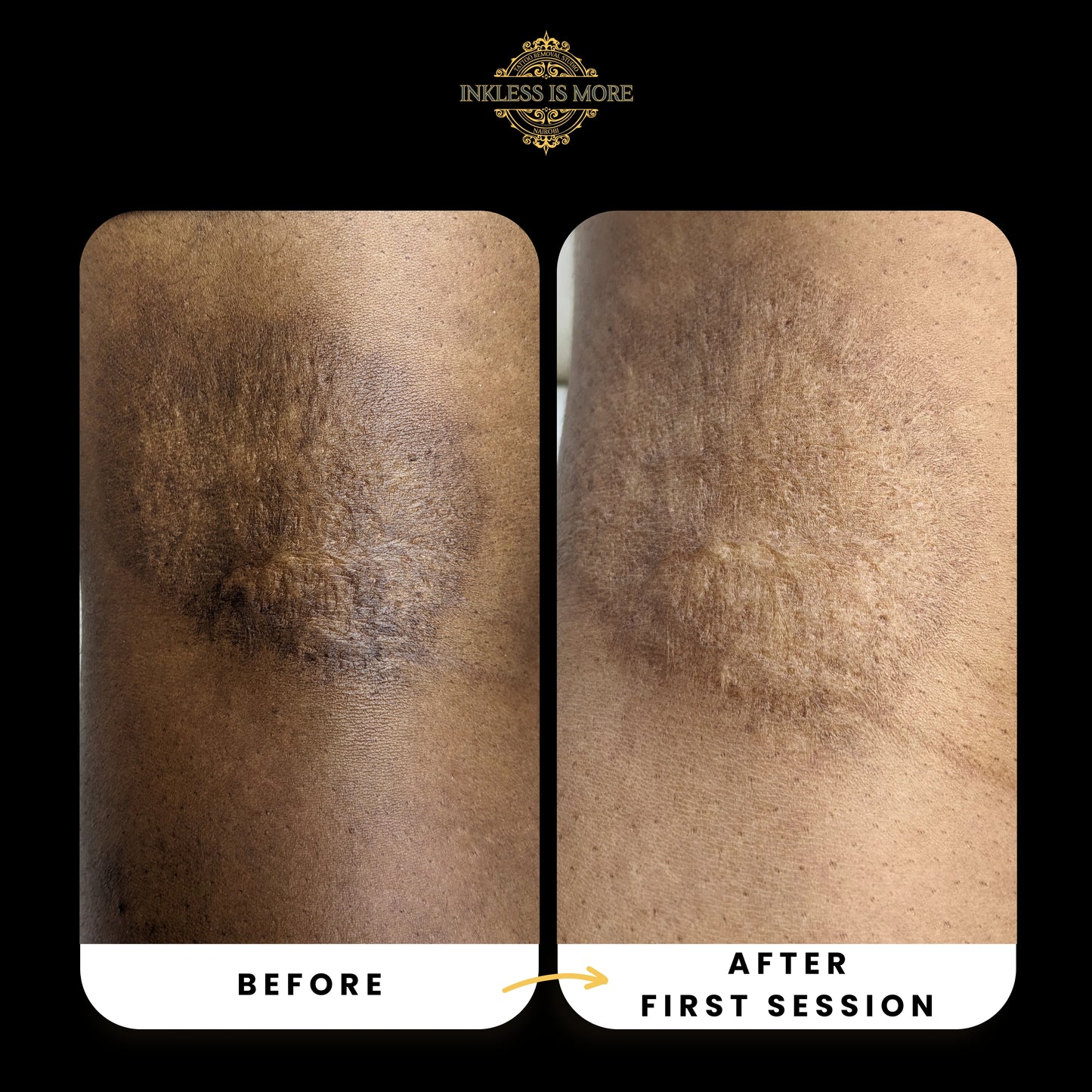 Laser Scar Treatment at Inkless is More