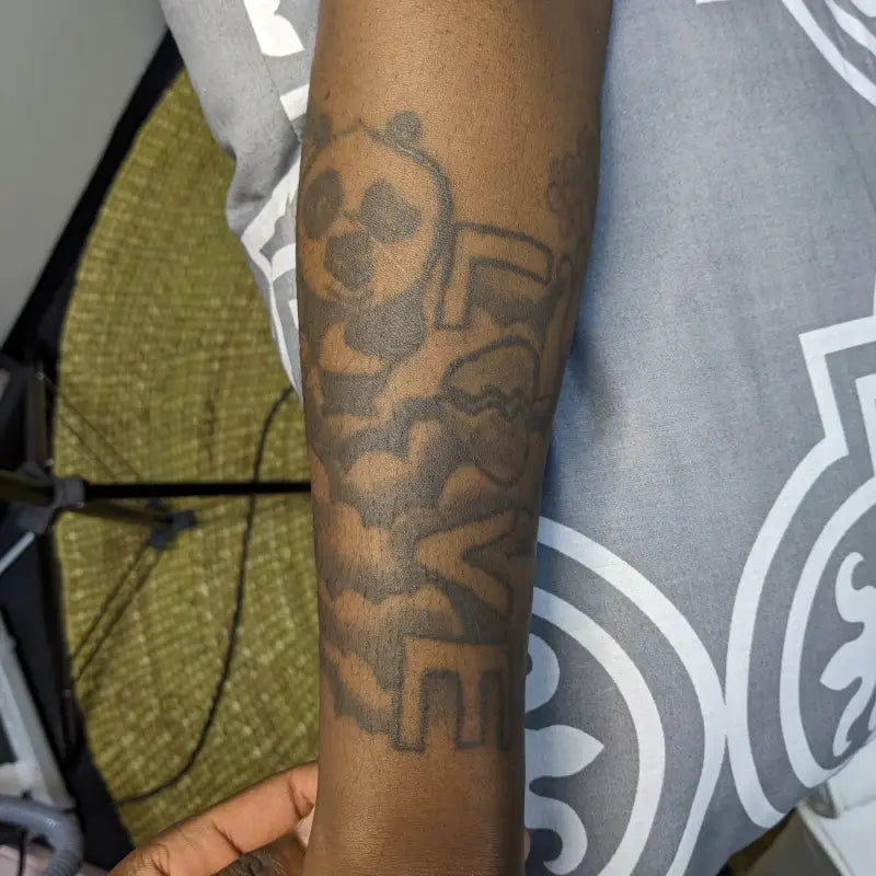 Unlimited Laser Tattoo Removal Sessions Package For Complete Tattoo Removal - Unlimited Laser Treatment Sessions Package