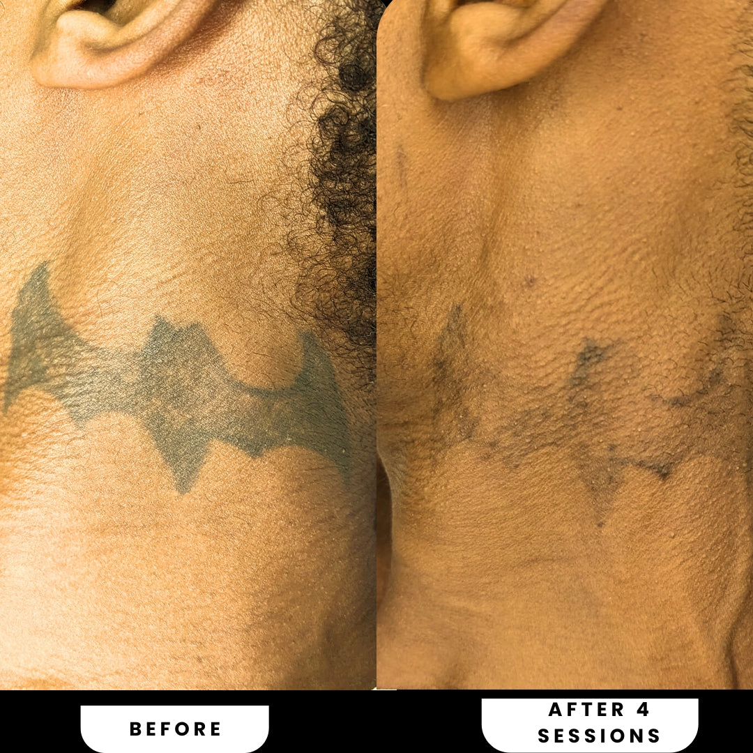 5 Laser Tattoo Removal Sessions (medium size tattoo)